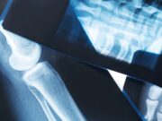 Attend the 2024 Hansjörg Wyss Orthopaedic Trauma Symposium Close-up of various X-ray images, including a knee and spinal vertebrae, displayed on a table.