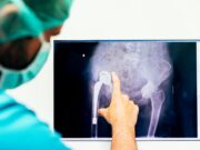 Challenges and Strategies in Total Hip Arthroplasty (THA) for Younger Patients A doctor in surgical attire analyzing an X-ray of a hip replacement.