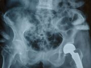 Post-Recall Preparedness: How Practices Are Screening and Managing Implant Failures