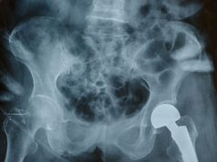 Post-Recall Preparedness: How Practices Are Screening and Managing Implant Failures