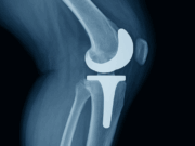 Is Age Still a Barrier to Cementless Fixation? Some Say No. Is Age Still a Barrier to Cementless Fixation