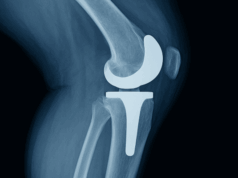 Is Age Still a Barrier to Cementless Fixation? Some Say No. Is Age Still a Barrier to Cementless Fixation
